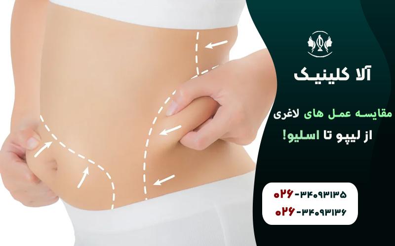 مقایسه عمل های لاغری (از لیپو تا اسلیو!)