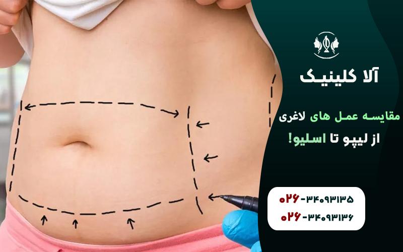 مقایسه عمل های لاغری (از لیپو تا اسلیو!)