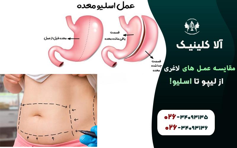 مقایسه عمل های لاغری (از لیپو تا اسلیو!)