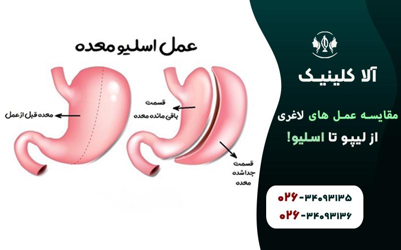مقایسه اسلیو معده با لیپوماتیک