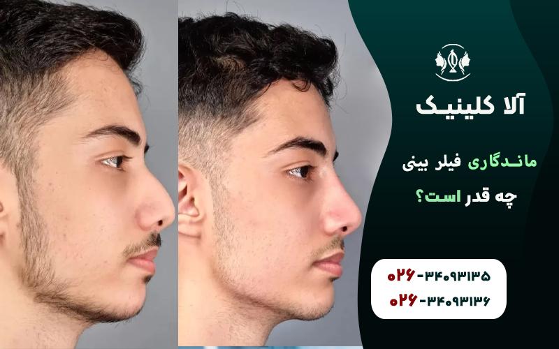 ماندگاری فیلر بینی چه قدر است؟ چه طور آن را افزایش دهیم