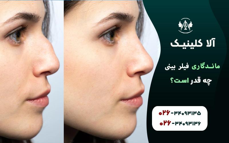 ماندگاری فیلر بینی چه قدر است؟