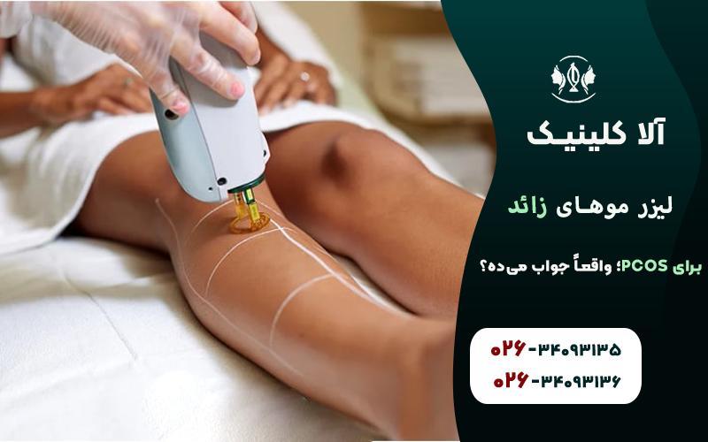 لیزر موهای زائد در زنان با سندرم تخمدان پلیکیستیک