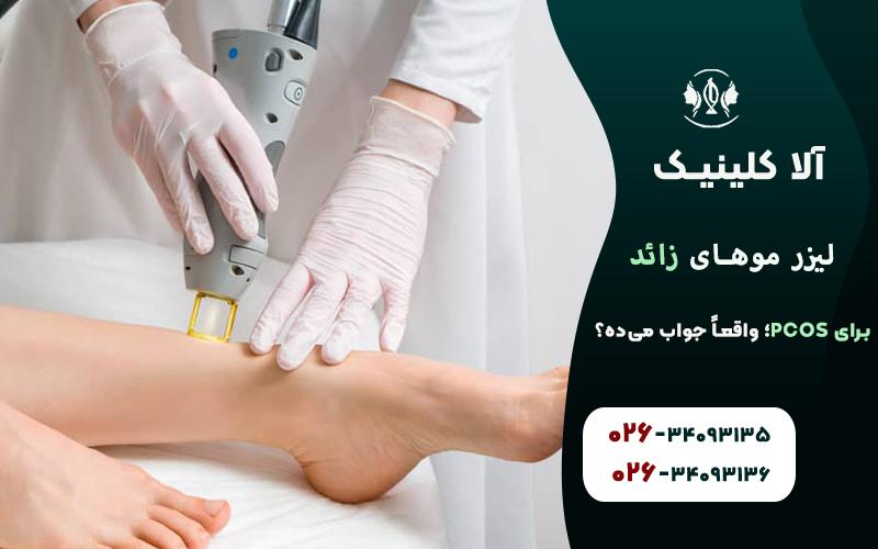 مقایسه ماندگاری لیزر در افراد مبتلا به تخمدان پلیکیستیک