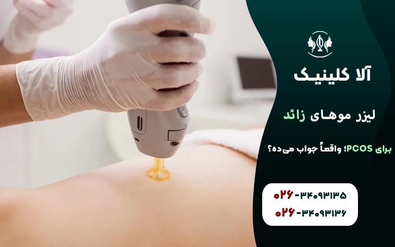 نتیجه لیزر موهای زائد در زنان مبتلا به PCOS