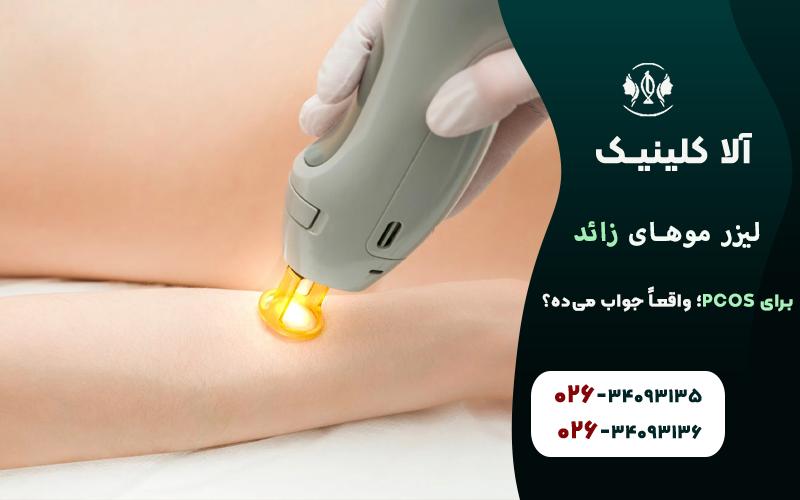 لیزر موهای زائد برای PCOS؛ واقعاً جواب میده