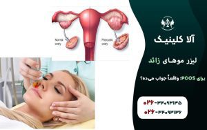 لیزر موهای زائد برای PCOS؛ واقعاً جواب میده