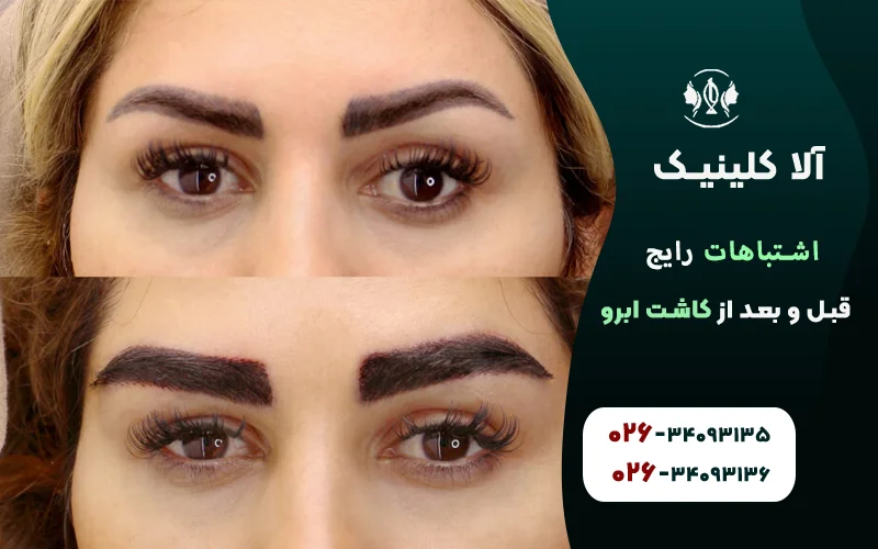 اشتباهات رایج قبل و بعد از کاشت ابرو