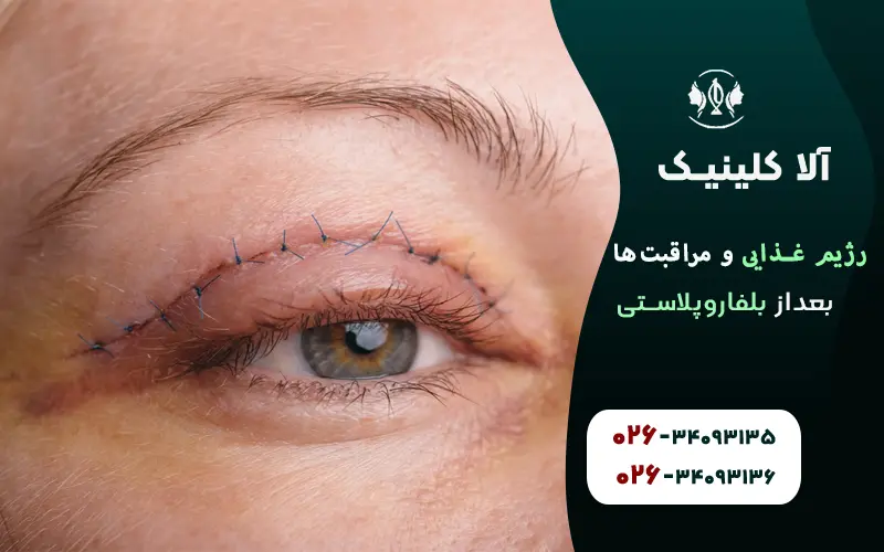 رژیم غذایی و مراقبتهای بعد از بلفاروپلاستی