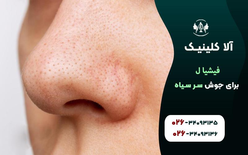 فیشیال برای جوش سرسیاه