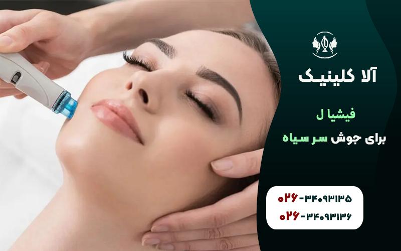 فیشیال برای جوش سرسیاه