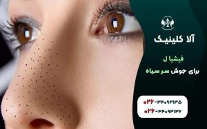 فیشیال برای جوش سرسیاه