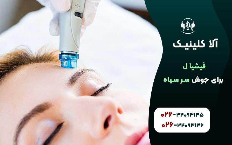 فیشیال برای جوش سرسیاه