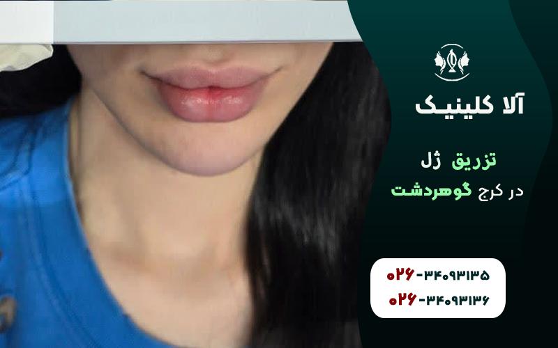 هزینه تزریق ژل در کرج