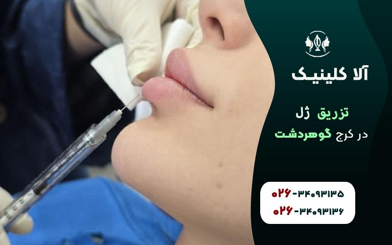 تزریق ژل در کرج گوهردشت