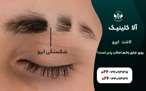 کاشت ابرو روی جای زخم بخیه