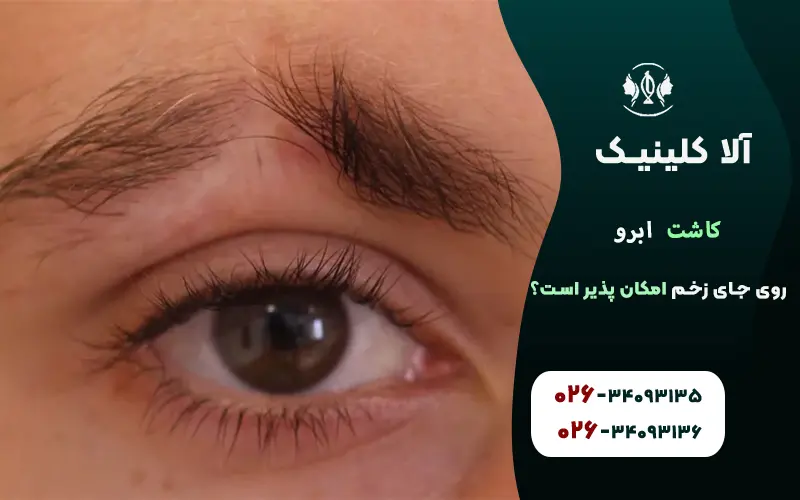 کاشت ابرو روی جای زخم بخیه