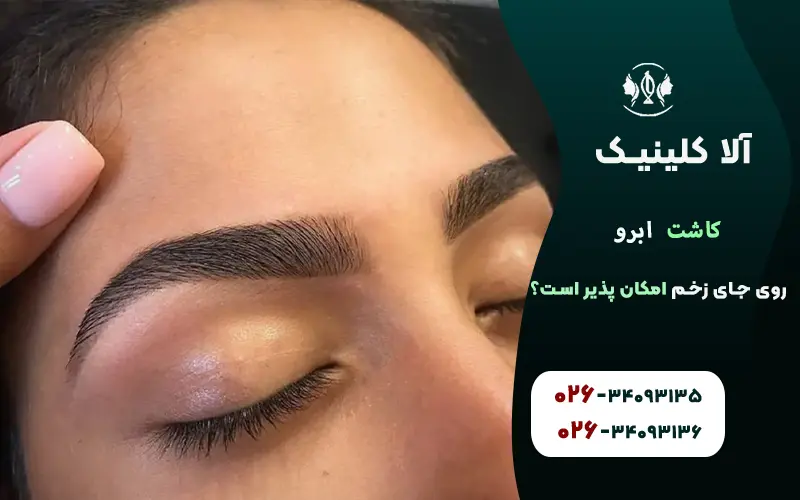 کاشت ابرو روی جای زخم بخیه