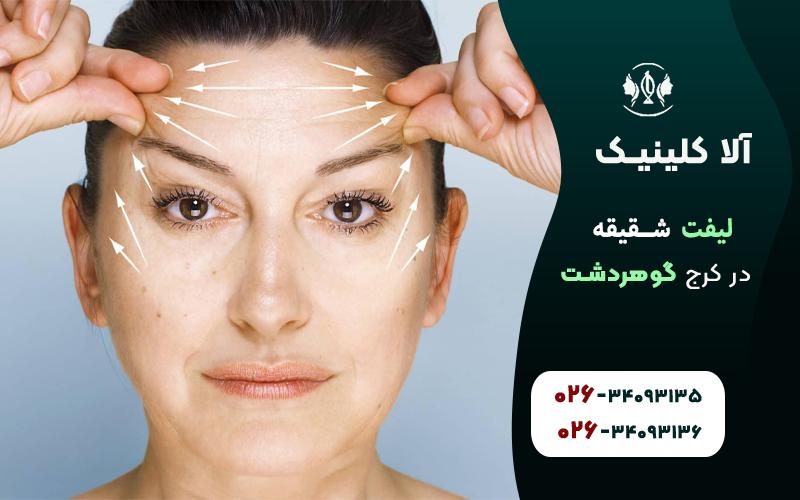 لیفت شقیقه در کرج