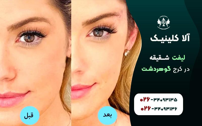 لیفت شقیقه در کرج قبل و بعد جراحی