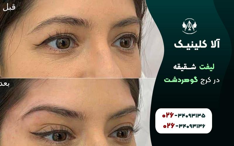 لیفت شقیقه قبل و بعد