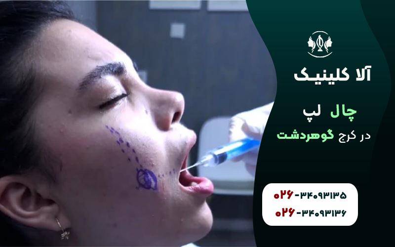 چال لپ طبیعی