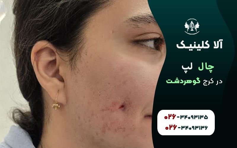 چال گونه در کرج