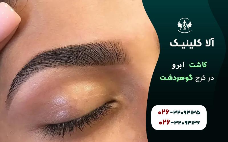 هزینه کاشت ابرو در کرج