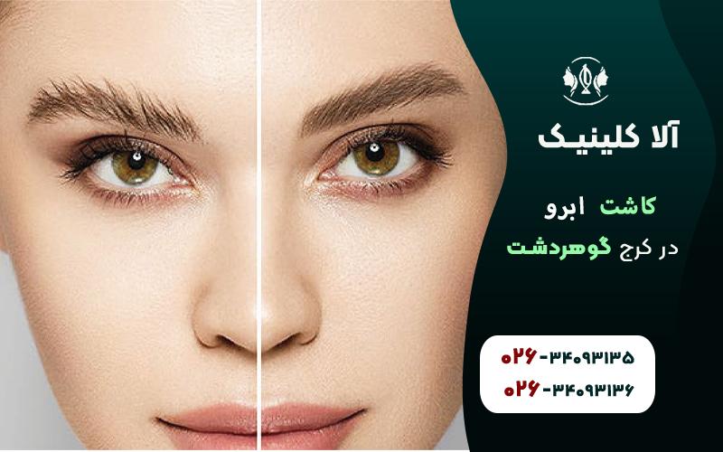 کاشت ابرو در کرج گوهردشت