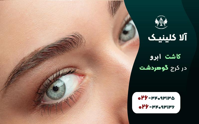 کاشت ابرو در کرج