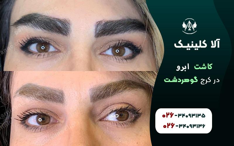 تصویر قبل و بعد از کاشت ابرو در کرج