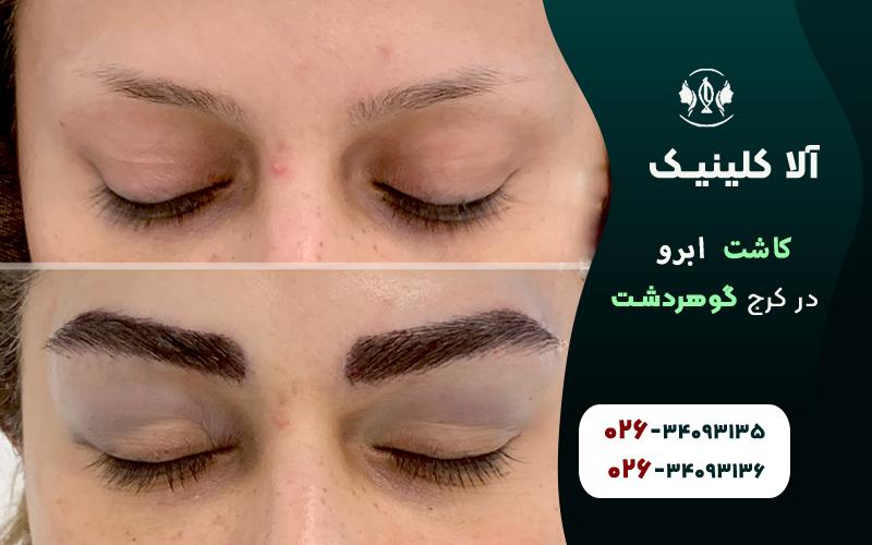 کاشت ابرو در کرج