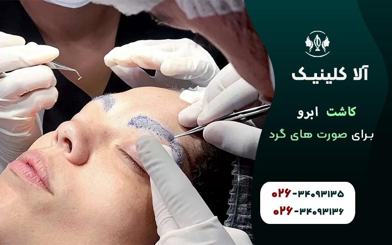 کاشت ابرو برای صورت های گرد