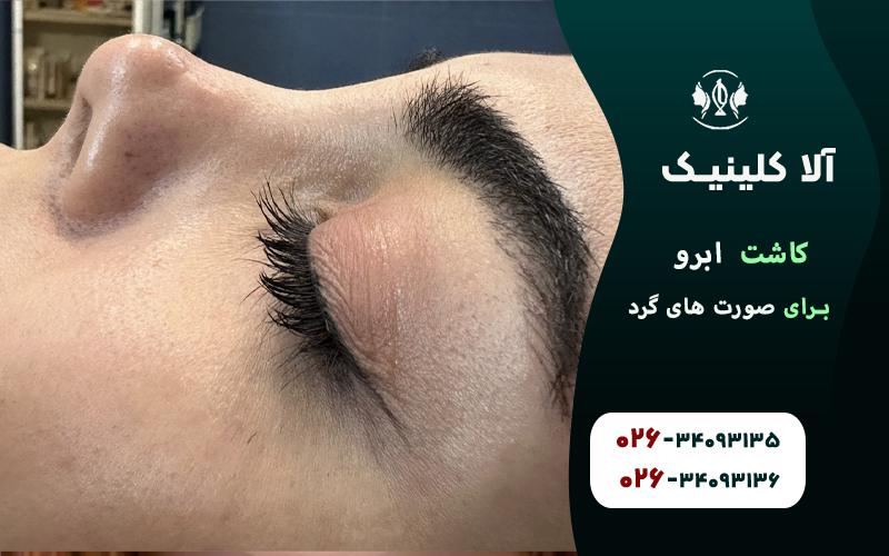 کاشت ابرو برای صورت های گرد