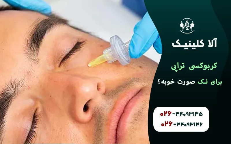 کربوکسی تراپی برای لک صورت خوبه
