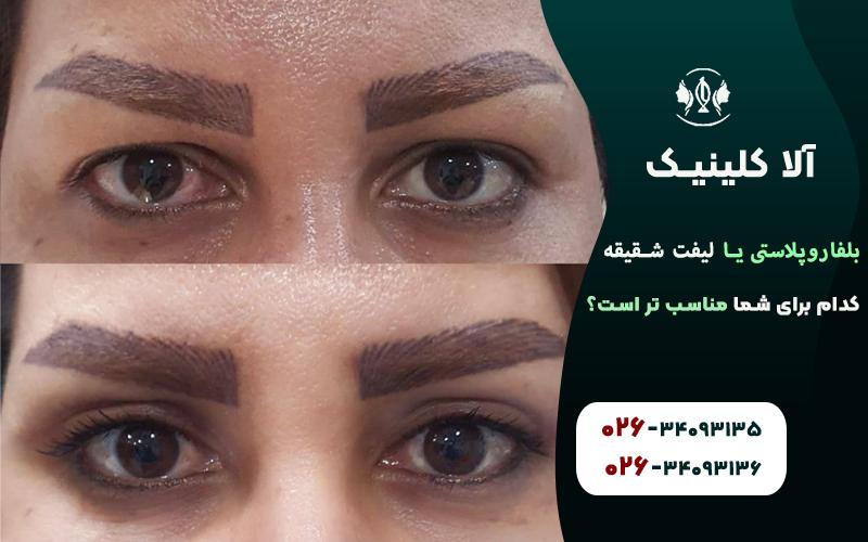 بلفاروپلاستی یا لیفت شقیقه،کدام برای شما مناسب تر است