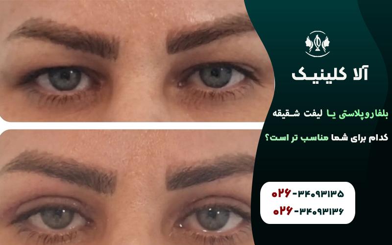 بلفاروپلاستی یا لیفت شقیقه،کدام برای شما مناسب تر است