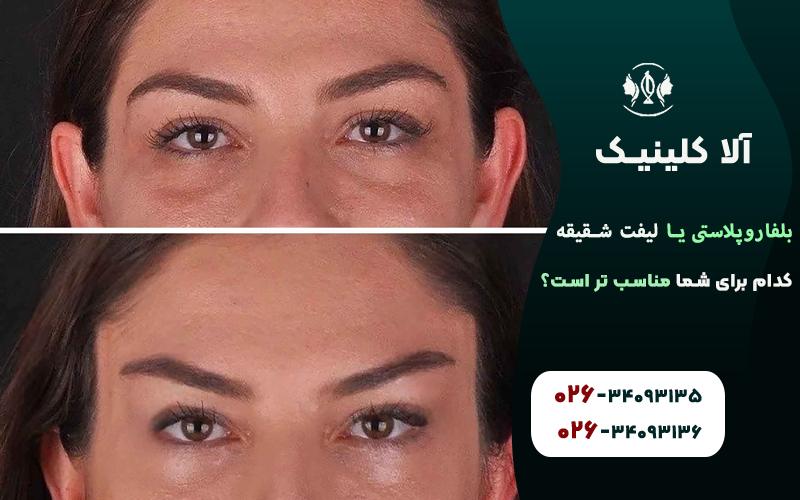 بلفاروپلاستی یا لیفت شقیقه،کدام برای شما مناسب تر است