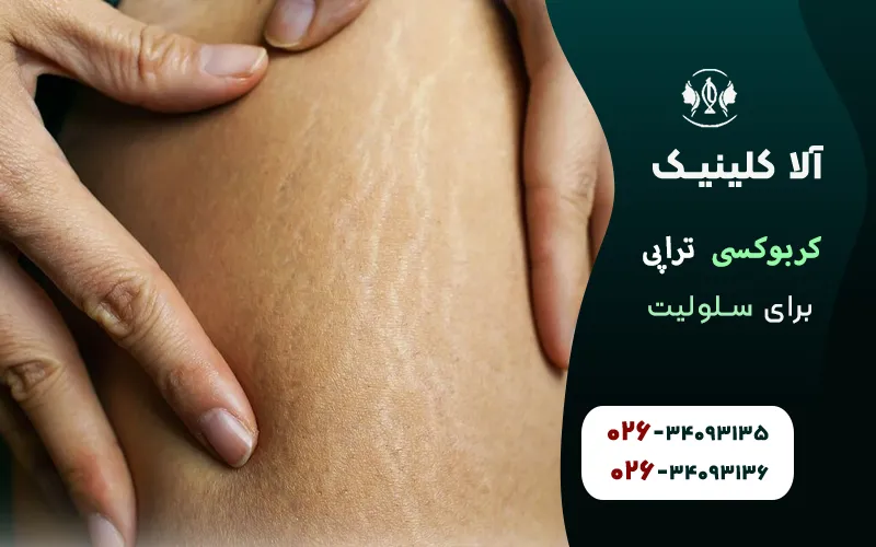 کربوکسی تراپی برای سلولیت و نکاتی که باید بدانید