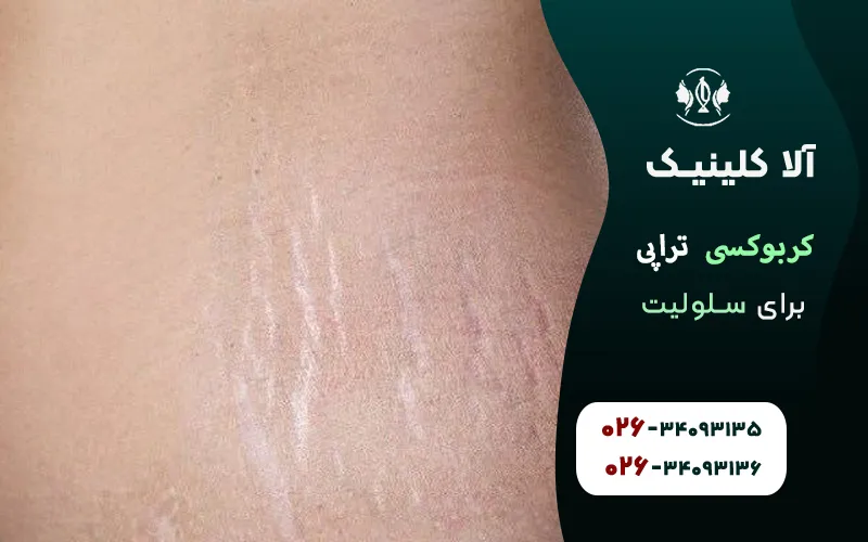 کربوکسی تراپی برای سلولیت و نکاتی که باید بدانید