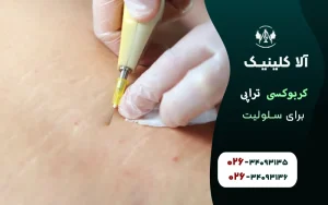 کربوکسی تراپی برای سلولیت و نکاتی که باید بدانید