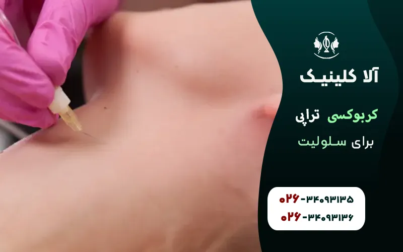 کربوکسی تراپی برای سلولیت و نکاتی که باید بدانید