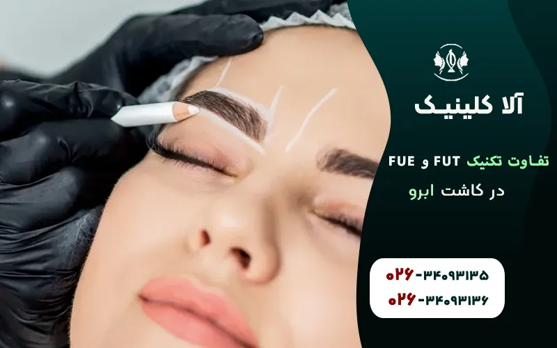 تفاوت تکنیک FUT و FUE در کاشت ابرو