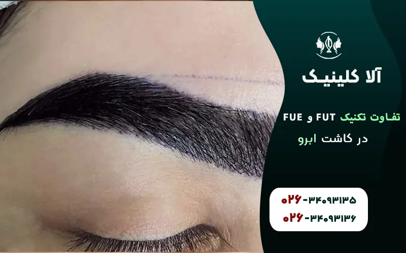 تفاوت تکنیک FUT و FUE در کاشت ابرو