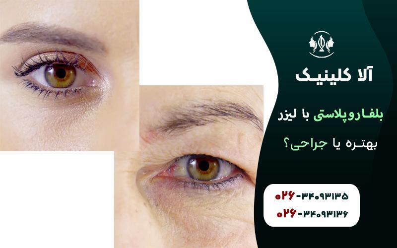 بلفاروپلاستی با لیزر بهتره یا جراحی