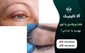 بلفاروپلاستی با لیزر بهتره یا جراحی