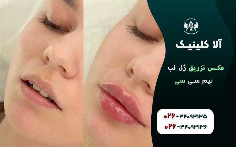 عکس تزریق ژل لب نیم سی سی قبل و بعد