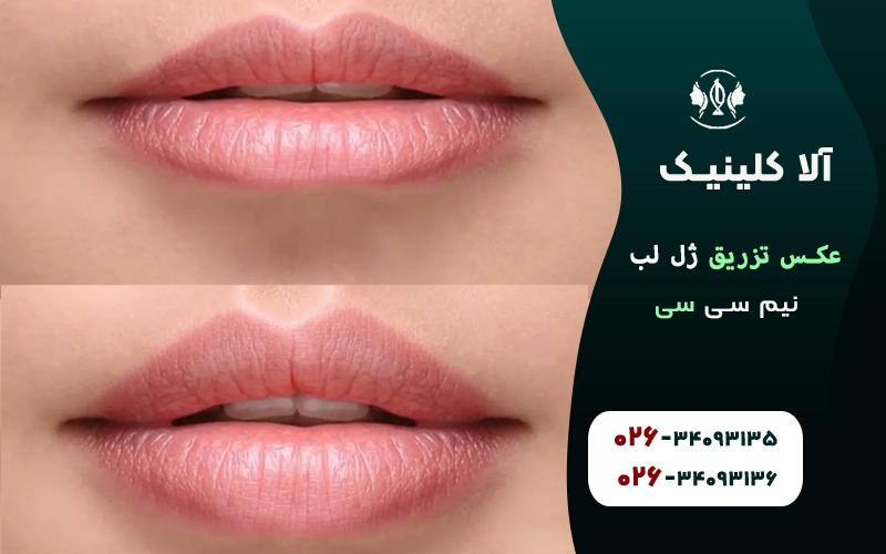 عکس تزریق ژل لب نیم سی سی