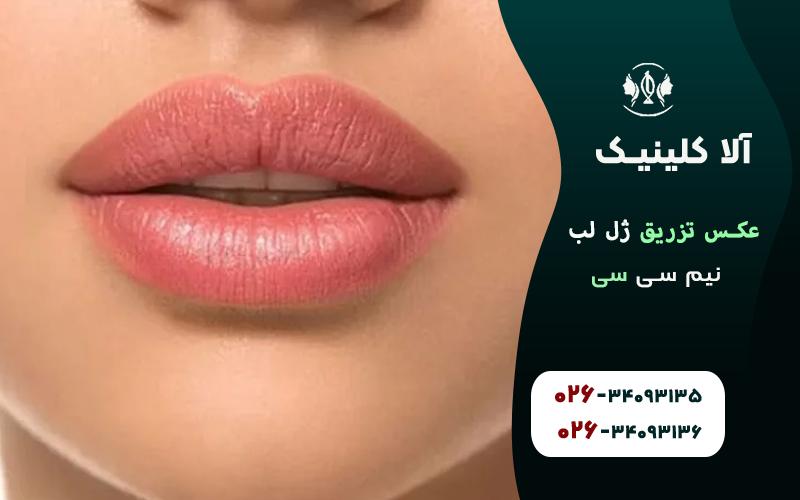 عکس تزریق ژل لب نیم سی سی