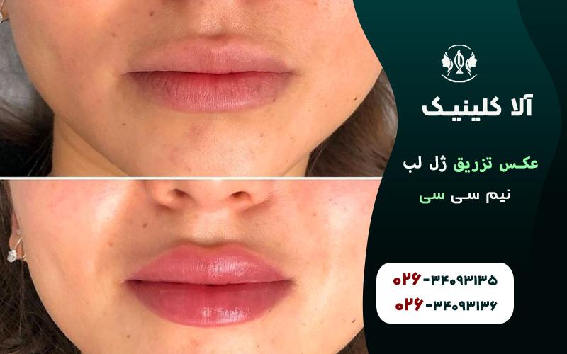 عکس تزریق ژل لب نیم سی سی